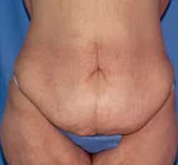 Abdominoplasty