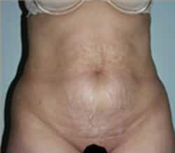 Abdominoplasty