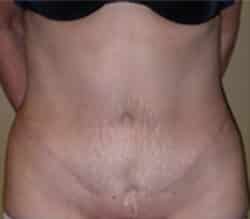 Abdominoplasty