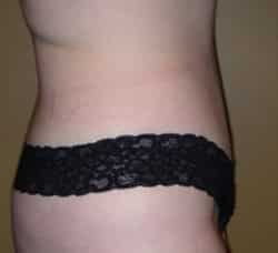 Abdominoplasty