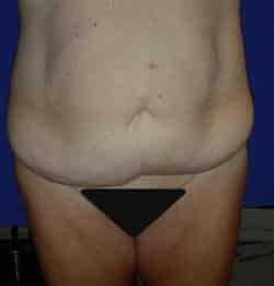 Abdominoplasty