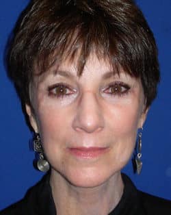 Blepharoplasty