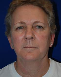 Blepharoplasty