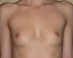 Breast Augmentation