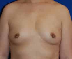 Breast Augmentation
