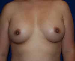 Breast Augmentation
