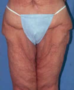 Lower Body Lift