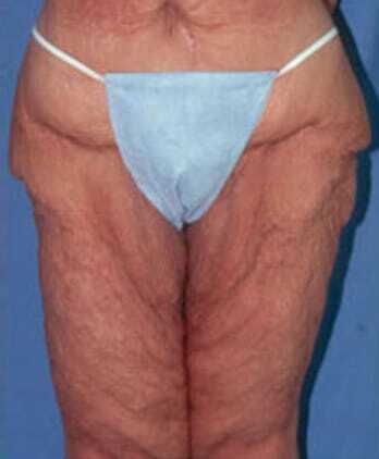 Lower Body Lift