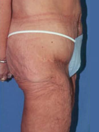 Lower Body Lift