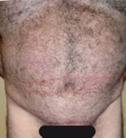 Panniculectomy