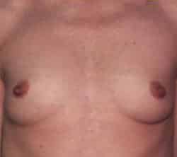 Breast Augmentation