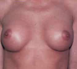 Breast Augmentation
