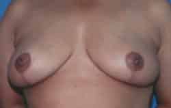 Breast Reduction