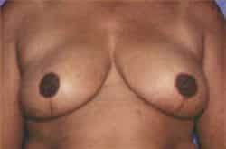 Breast Reduction