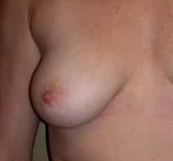 Mastopexy Augmentation