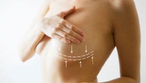 Breast Augmentation With Lift