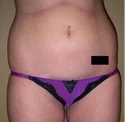 Liposuction