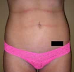 Liposuction