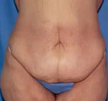 abdominoplasty